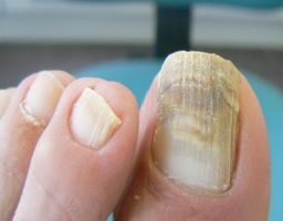 hongos de las uñas de los pies