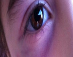 un ojo morado