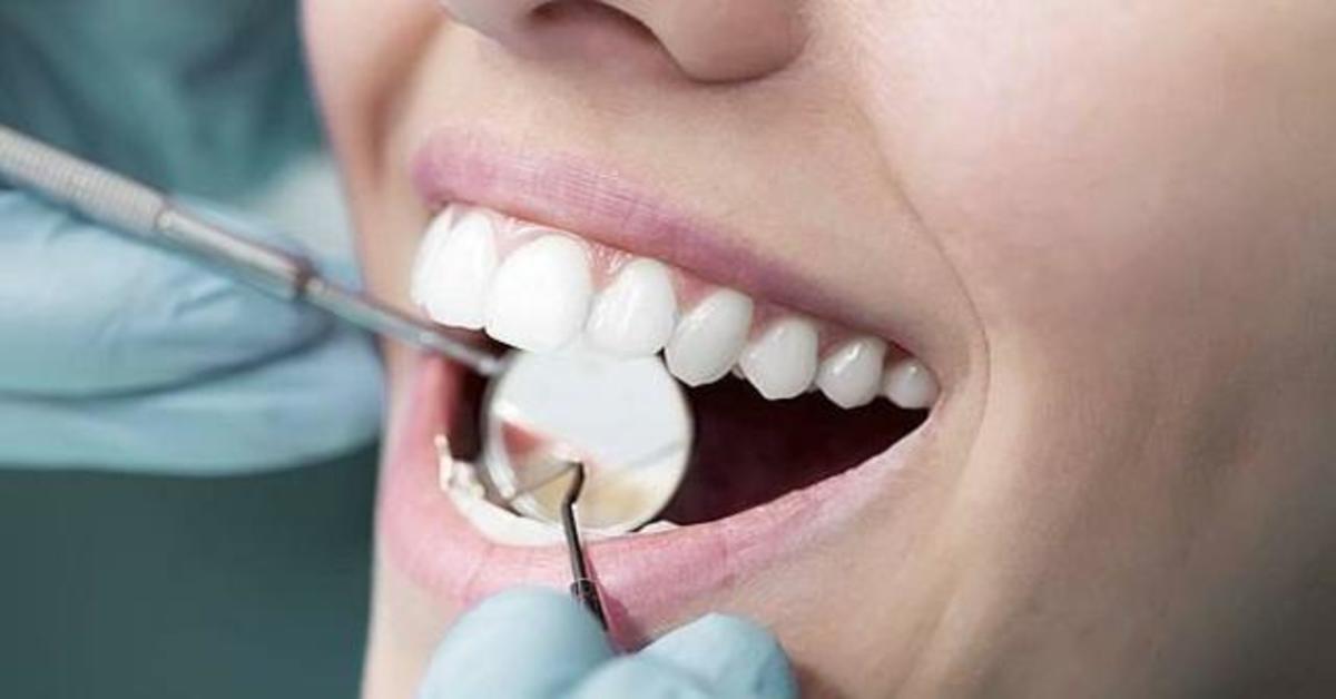 Cómo quitar el pegamento dental: Muy fácil paso a paso